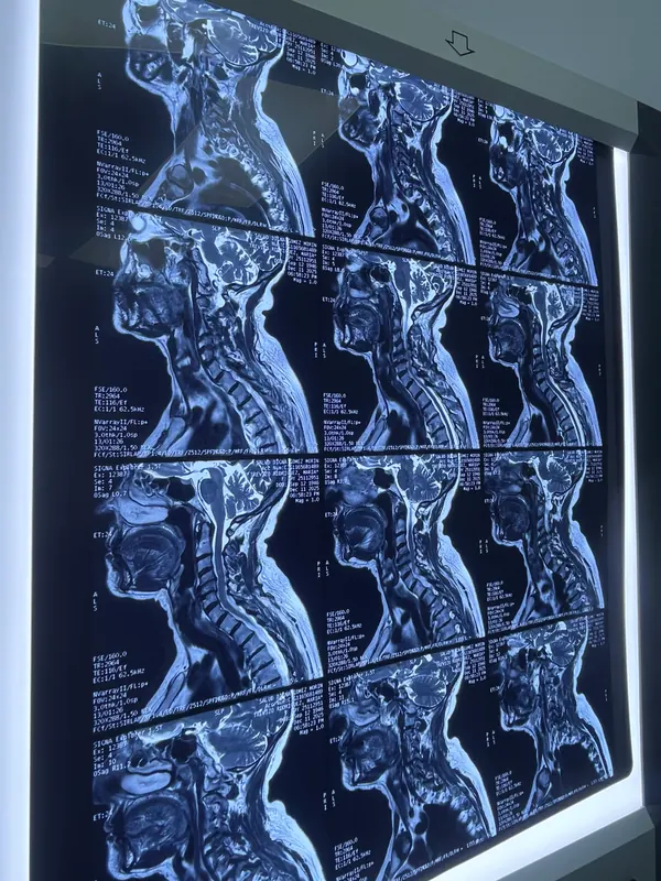 Resonancia magnética de columna cervical en el negatoscopio